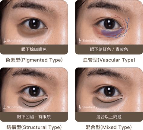 眼睛周圍黑|你的「黑眼圈」是哪一型？血管型、色素型、結構型.